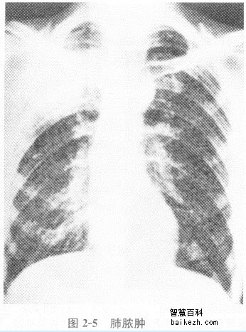肺脓肿预防和治疗