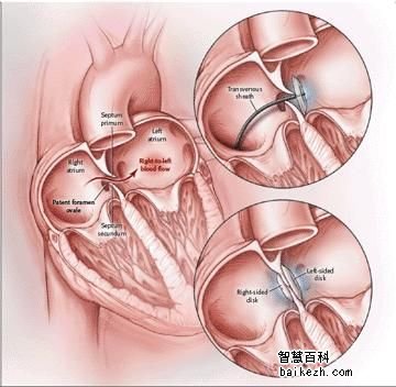 动脉导管未闭治疗方法有哪些？