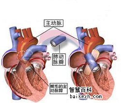 单纯性肺动脉瓣狭窄的病因