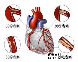 动脉硬化心脏病的治疗哪种方法合适？
