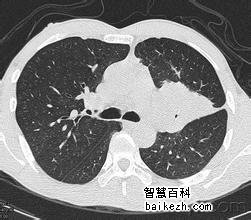 患了肺癌如何诊断？