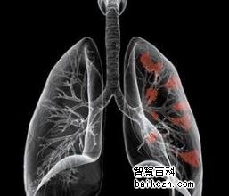 肺癌术后如何忌口?