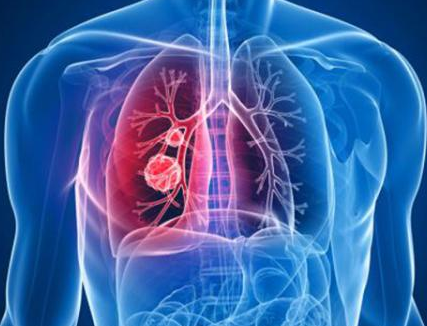 老年人患上肺炎该如何治疗？