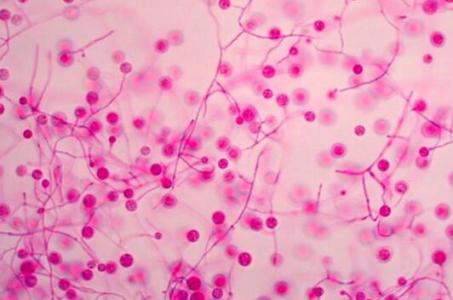 患上产气荚膜杆菌性脓毒血症的病因及病理有什
