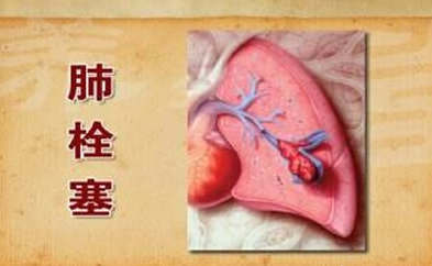 肺栓塞有哪些症状表现？