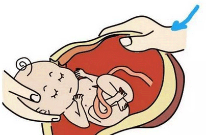 施行剖腹产治疗胎盘早期剥离须注意什么