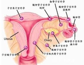 异位妊娠之什么是卵巢妊娠?