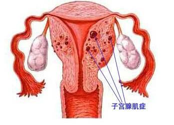 子宫腺肌症的早期症状有什么?