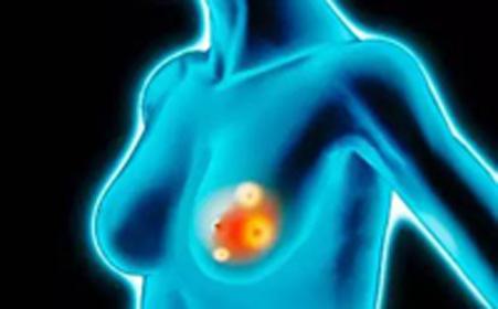 什么是乳腺结核及病因临床表现和检查治疗