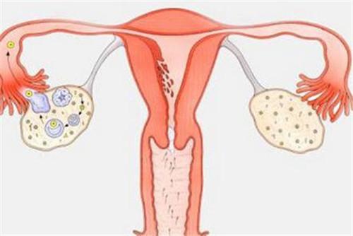 多囊卵巢综合征的表现和诊断及治疗