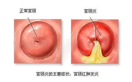 宫颈炎的常见病因及治疗方法