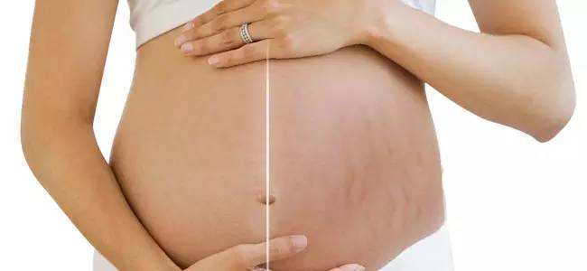 妊娠纹的形成原因及如何预防
