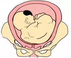 引起胎位不正的诱因，孕妈胎位自我矫正方法