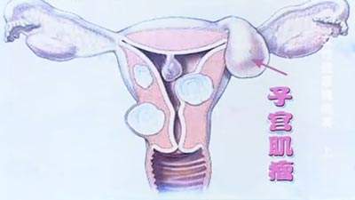 子宫肌瘤的检查项目及危害和治疗