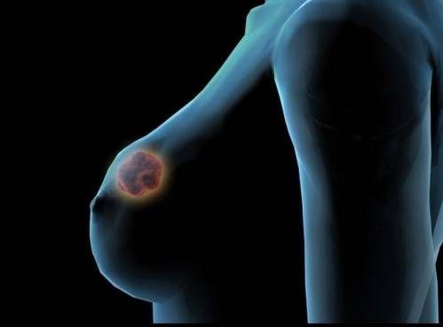 乳房肿块原因及种类