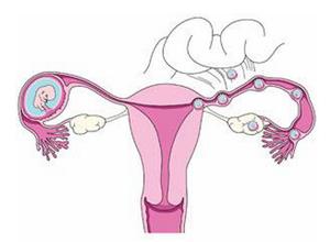 宫外孕的危害及饮食护理和中药治疗方法