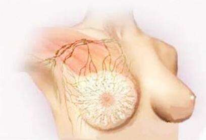乳腺为什么会增生?如何预防乳腺增生
