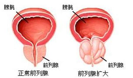 前列腺增生的8大典型症状