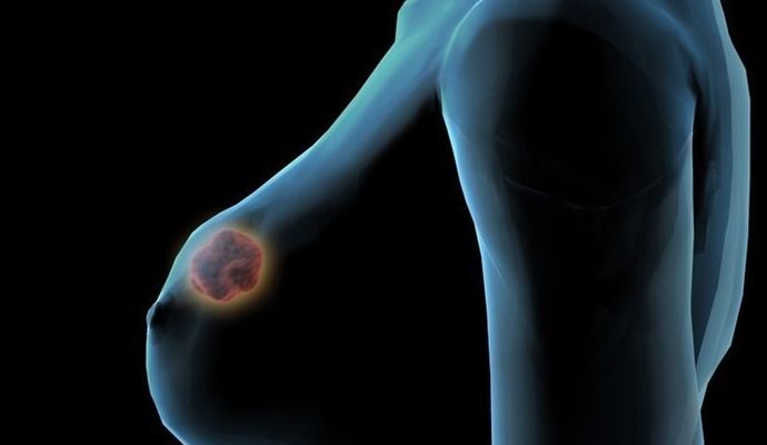 乳腺增生的症状及原因？如何诊断治疗和预防