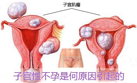女性必看!引起子宫肌瘤的7大原因