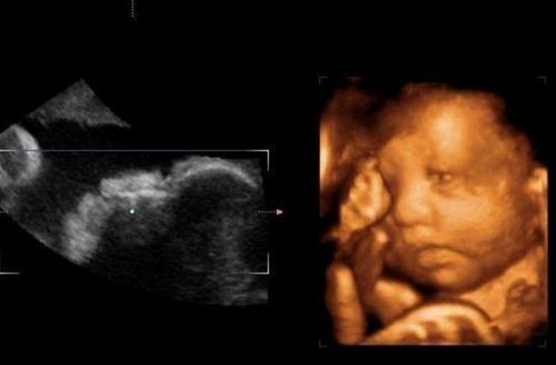 广安5个月胎儿四维彩超