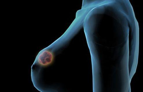 乳腺癌的两大预警 乳房按摩手法