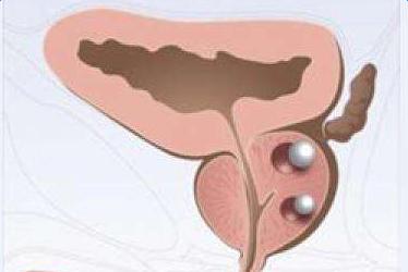 前列腺结石的发作原因及用药重点和饮食原则