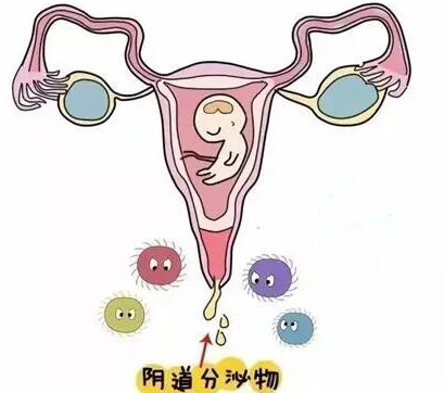 准妈妈孕期阴道分泌物增多，这是正常现象吗?