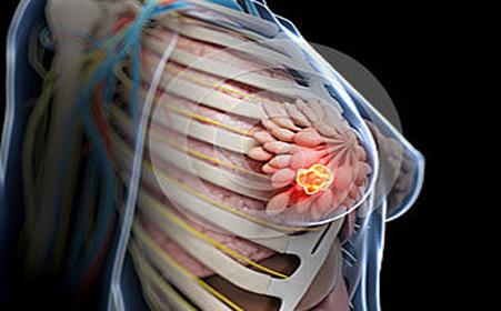 内江妇科必康网指出：乳腺纤维瘤的6种预防措施！