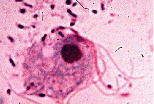 男性生殖器念球菌有哪些症状？需要注意些什么？