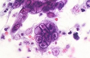 男性生殖器疱疹症状有哪些？生殖器疱疹应该怎么治疗？