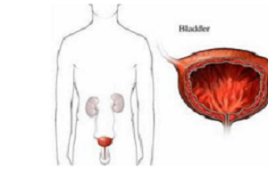 男人引起膀胱炎的原因有哪些？膀胱炎的注意事项有哪些？