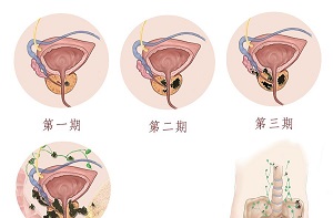 前列腺癌原因是什么？男人常吃这3类食物小心得前列腺癌！