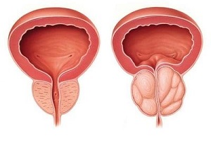 前列腺肥大的症状是什么样的？前列腺肥大的中药方有？