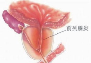男性前列腺脓肿的5种表现让你提前发现疾病！