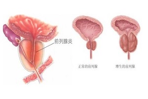 前列腺正常标准是多大？前列腺该如何保养？